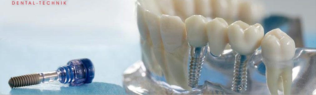 NAHR Dental Technik - Implantologie
